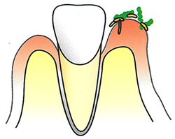 カビが歯茎について根を下ろし炎症を起こします。