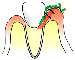 炎症によって歯茎が腫れ、歯と歯茎の間の溝が汚れやすくなり、カビがさらに奥で炎症を起こします。