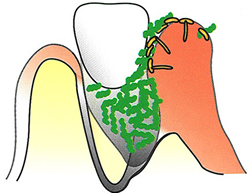 骨はさらに溶け歯周病ポケットはさらに深くなり、さらに多くの菌がたまっていきます。