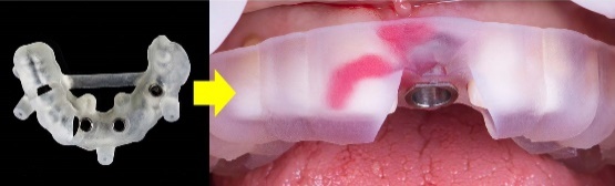 インプラントガイドの使用