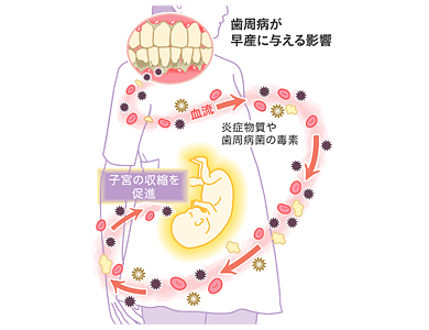 歯周病について