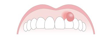 妊娠性エプーリス