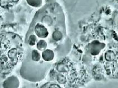 歯肉アメーバ（原虫）