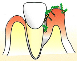 歯と歯茎の間にポケットができます。歯周病ポケットといいます。ここに歯周病菌がたまり、炎症がひどくなり、骨が溶けていきます。