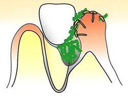 歯周病ポケットがさらに深くなり、よりたくさんの菌がたまっていきます。