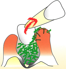 炎症によって歯茎が腫れ、歯と歯茎の間の溝が汚れやすくなり、カビがさらに奥で炎症を起こします。